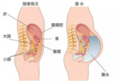 取卵后出现腹水怎么办？别慌 轻度腹水一周就好了