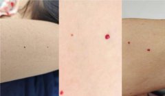 身上这种小红点可能是良性血管瘤
